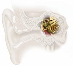 Disease affecting the external and/or middle ear produce a CONDUCTIVE hearing loss: Disease affecting the cochlear and auditory nerves produce a SENSORINEURAL Loss